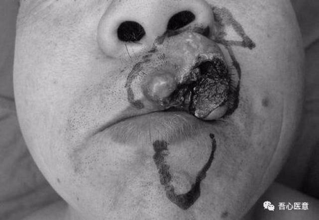 下唇癌手术后图片图片