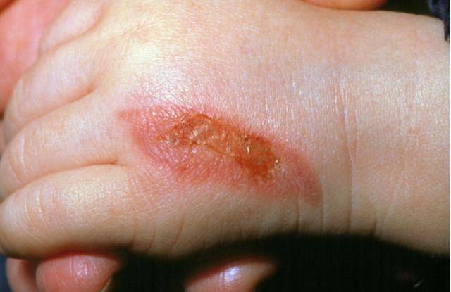 烧伤烫伤别再用土方法!只会加重伤口感染,正确急救5字口诀_手机搜狐网