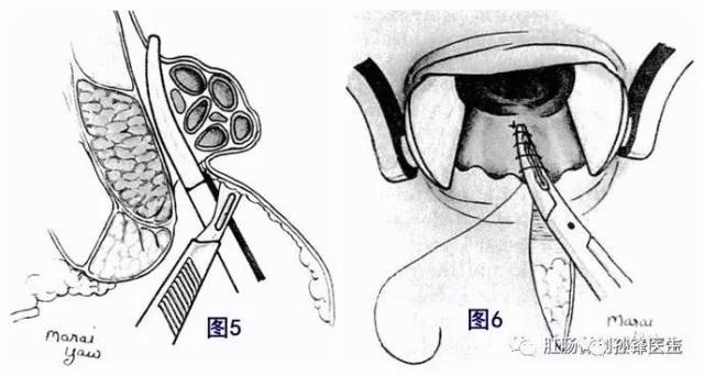 手术折刀位示意图图片