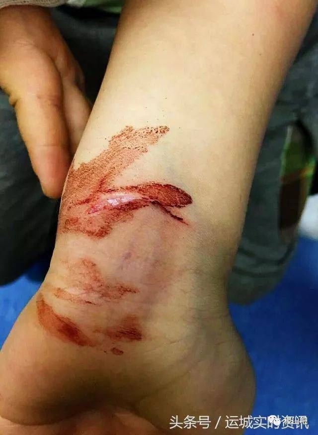 手臂伤疤照片流血图片