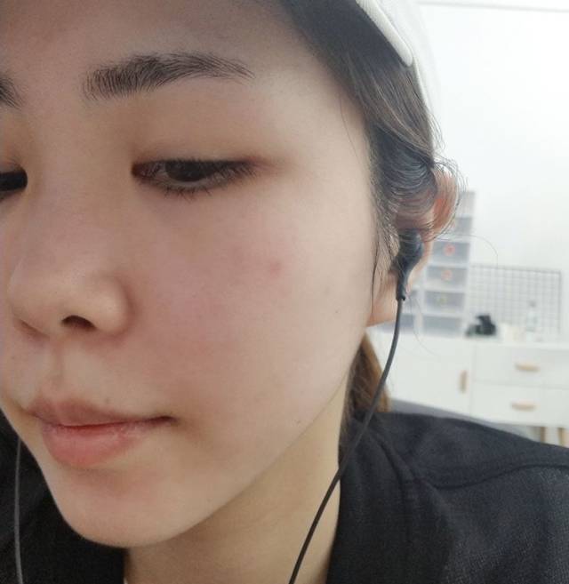 我是如何在10天内拯救过敏了一个半月的脸?