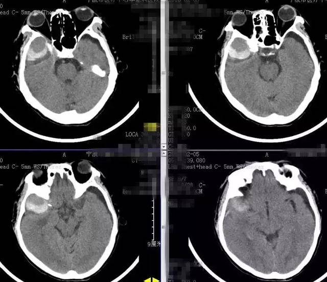头颅血肿图片