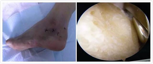 3, 跟腱滑囊炎镜下清理术