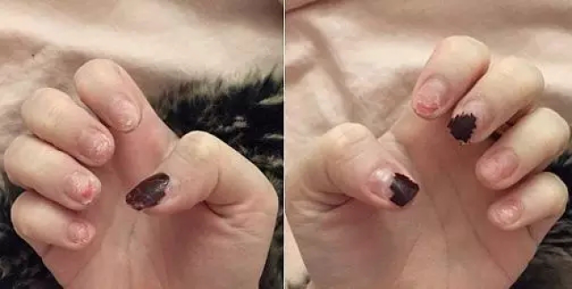 抠美甲带来了快感,却给指甲你想不到的伤害
