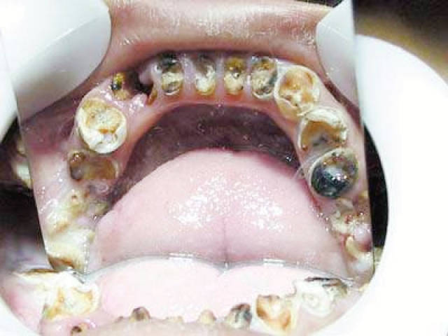 导致牙齿"烂掉"的元凶:_手机搜狐网