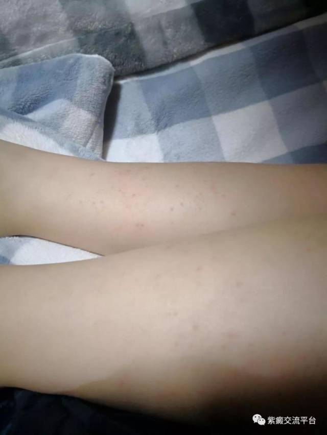 过敏性紫癜对称吗?