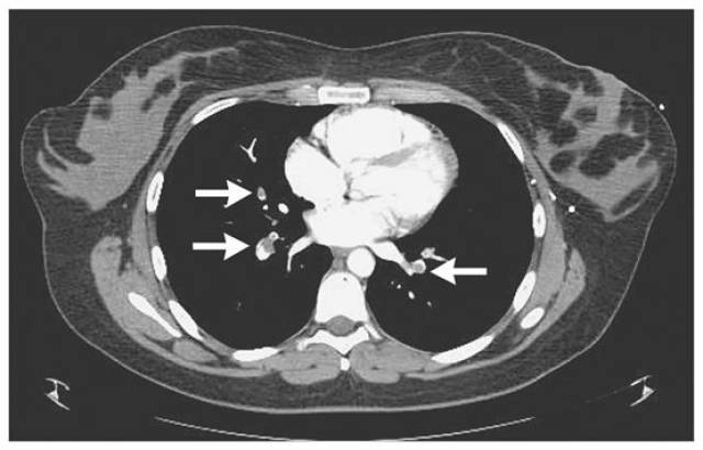 就有相当大的可能是 下肢深静脉血栓形成(deep venous thrombosis