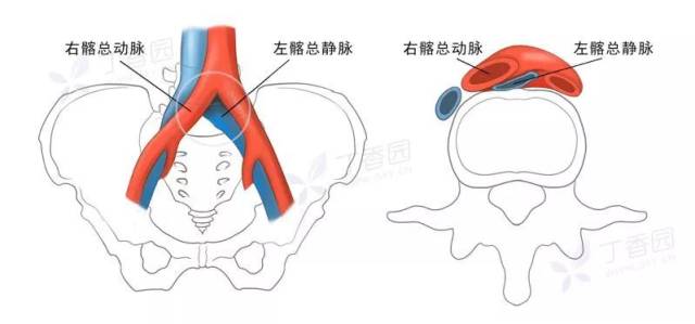 超声探头位于髂外静脉管腔内,黑色箭头指示压迫髂外静脉的髂内动脉