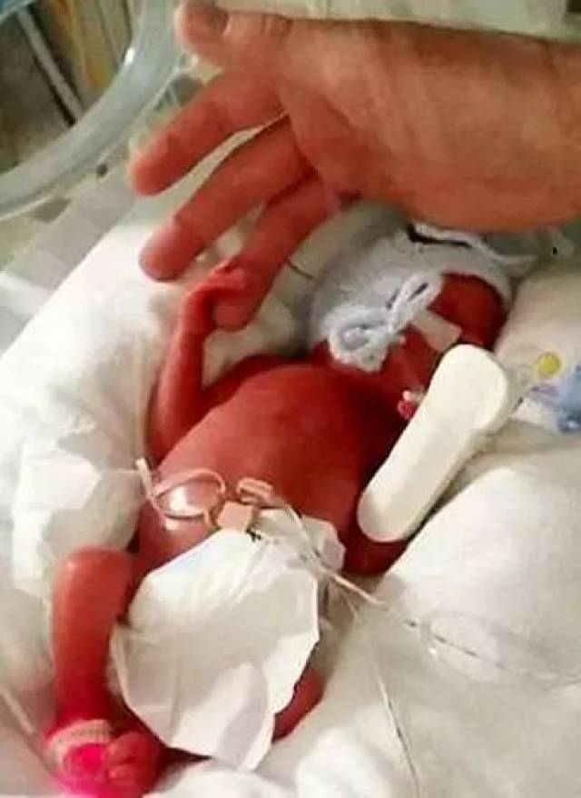 一个被医生判定死亡的20周早产儿,奇迹般的活了下来!