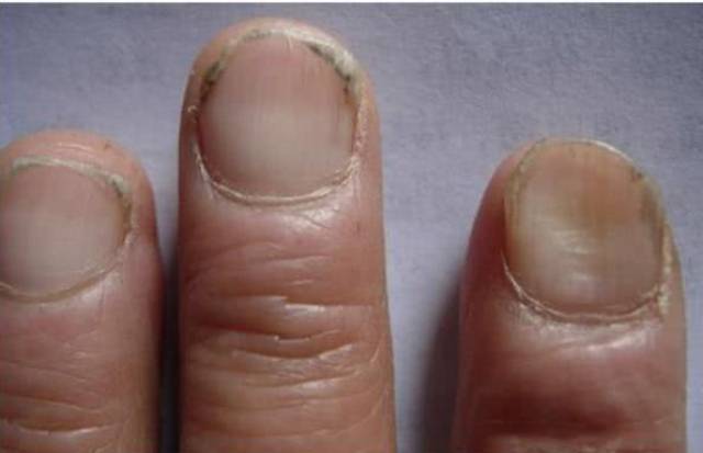 看指甲知健康,这5种指甲表现,哪怕是一种也是大病的表现