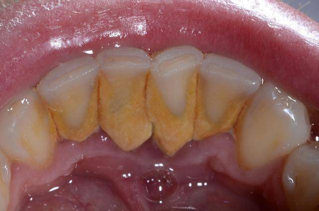 牙齿缝里抠出的黄色物质到底是啥?为什么那么臭?