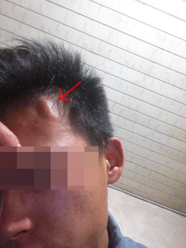 两小伙长肿块,竟是罕见木村病