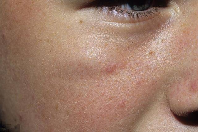 血脂高不高,看脸就一目了然,5种异常一出现,说明你该降脂了!