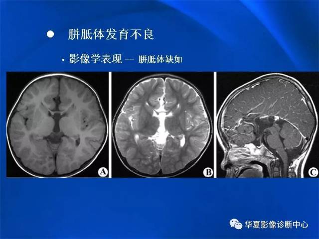 胼胝体解剖及各种病变的影像学表现