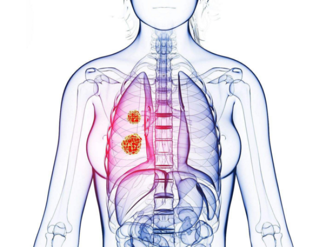 肺癌胸痛的位置图片