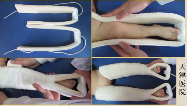 髋关节需要过度屈曲 在侧方垫高防止过度外展 case 牵引  2岁以内垂直