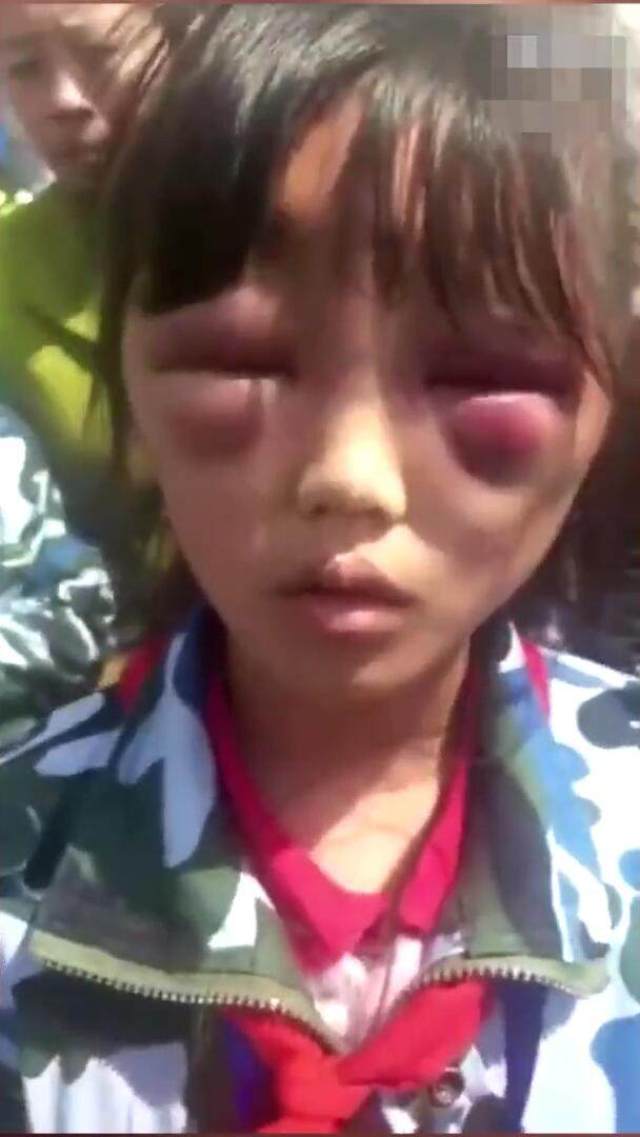 同时也掀起一阵舆论,视频中有一位小女孩眼睛已经被肿成熊猫