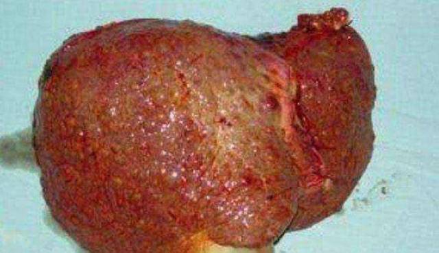 肝癌中期图片图片