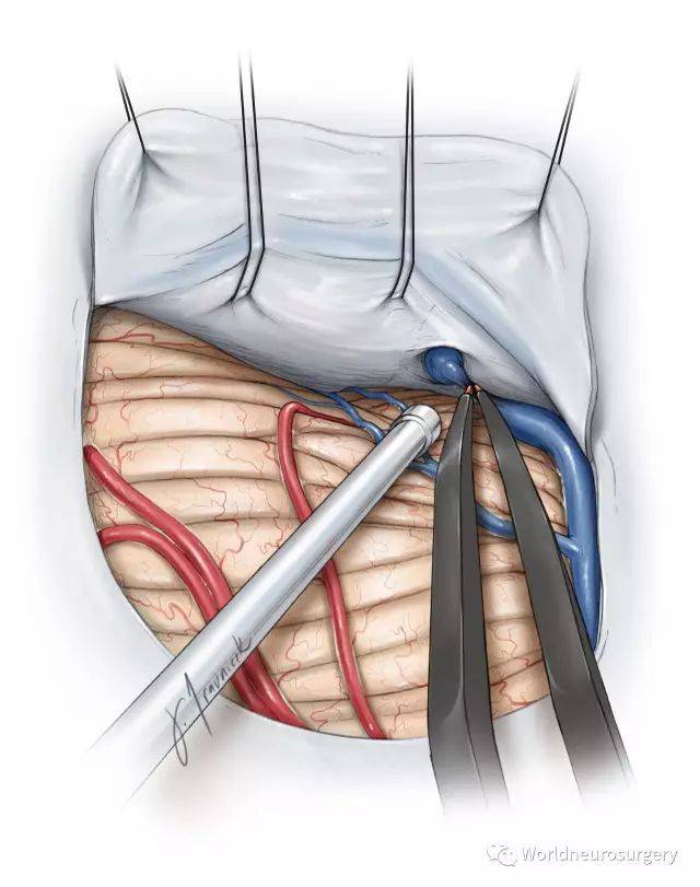 海马旁病变,试过经小脑幕入路吗?
