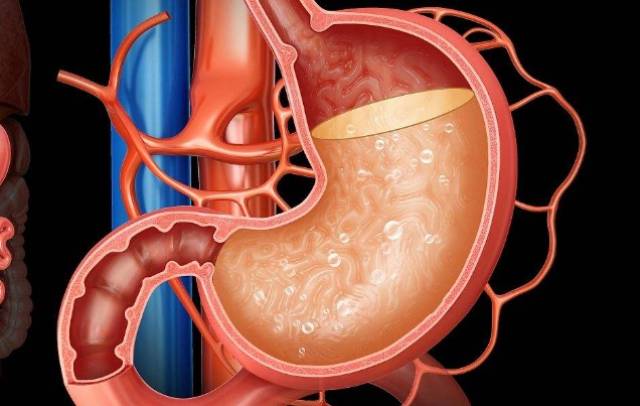 一,因胃酸过多表现的症状可细分如下
