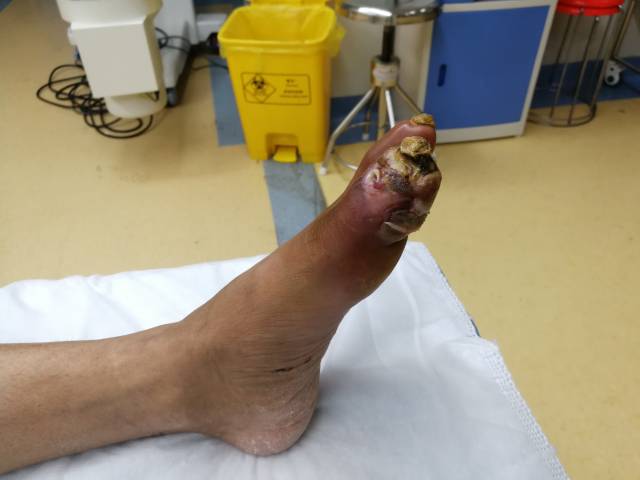 去除难忍之痛 告别截肢之苦 开创脉管炎诊疗新时代_手机搜狐网