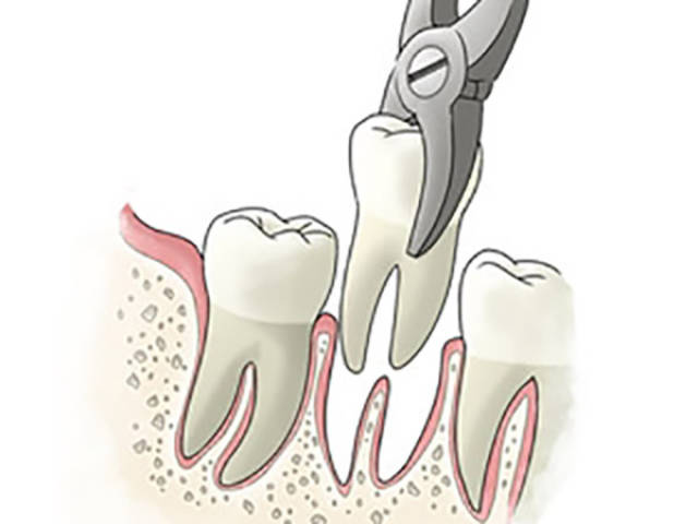 拔牙牙齒鬆動牙周病