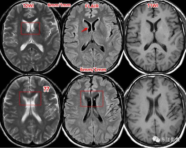 flair磁共振图片