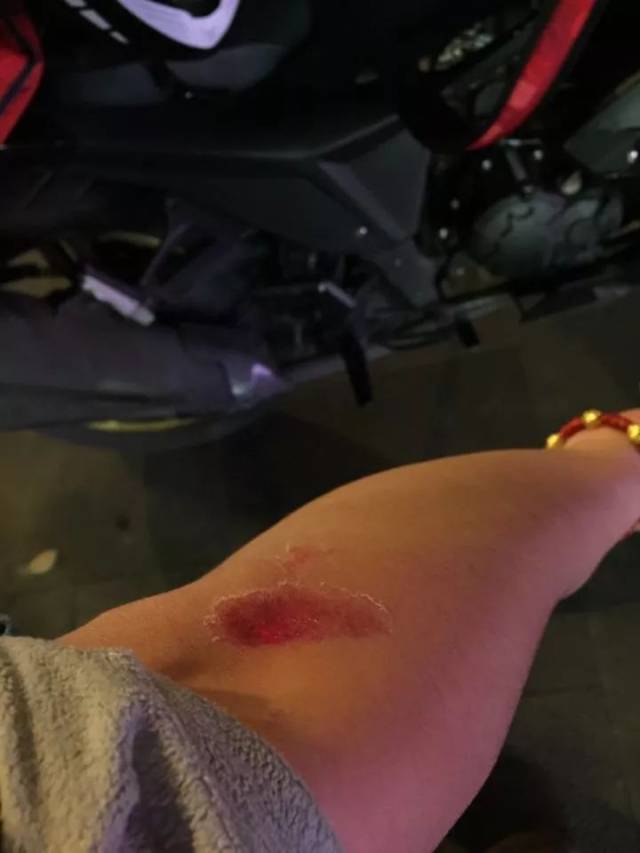 骑摩托车摔跤擦伤图片图片
