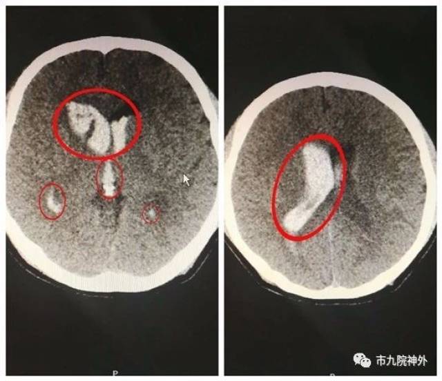 術前頭顱ct:右側基底節區腦出血,量約4ml