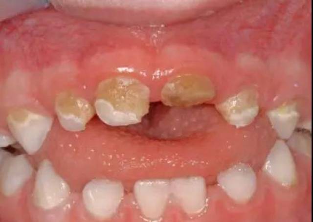 仅波及牙釉质的早期龋损,患牙可以完全没有疼痛和不适症状