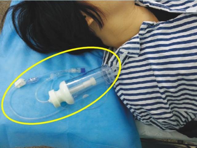 剖腹产用的止痛泵图片图片