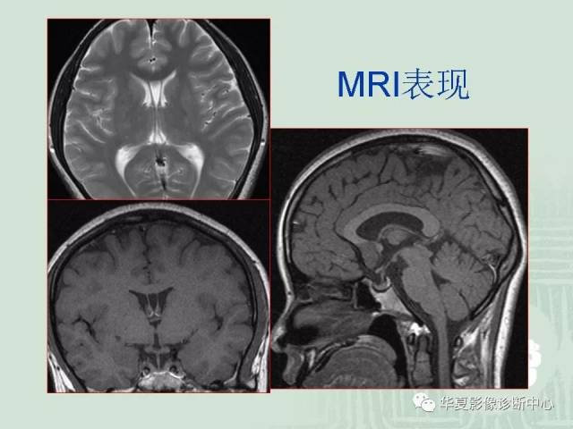 正常的脑部磁共振图片图片