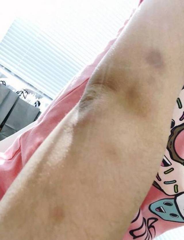 林允晒腿部淤青照不忍直视节食过度导致血小板下降