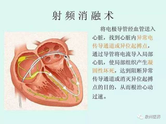 晋江中医院应用心脏射频消融术治疗心律失常