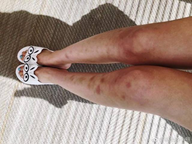 林允因的这双腿火了,惨不忍睹布满伤痕,刚刚公布原因