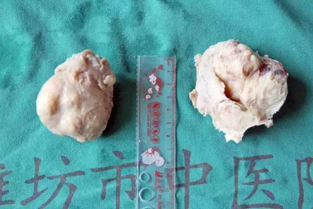 切除后的巨型前列腺标本