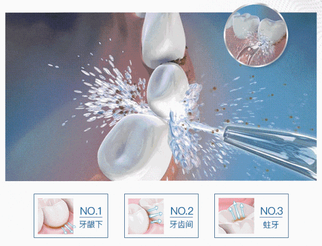 2. 使用洁碧冲牙器标准喷头清除牙菌斑比普通牙线有效 29%[2]