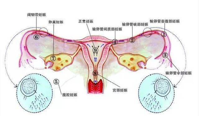 宫外孕图片 示意图图片