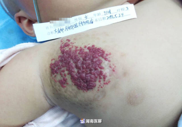 女婴右胸前血管瘤"红红一片",打针不哭不闹惹人心疼
