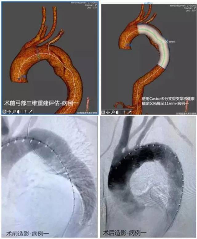 完成包括主動脈夾層,胸主動脈瘤,腹主動脈瘤,胸腹主動脈瘤,主動脈縮窄