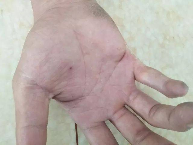 【爱岗敬业】乐峰派出所辅警潘建元为排除漏电隐患而受伤