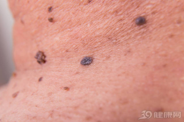 自查:皮肤上的痣有5个特征,说明皮肤癌在靠近!