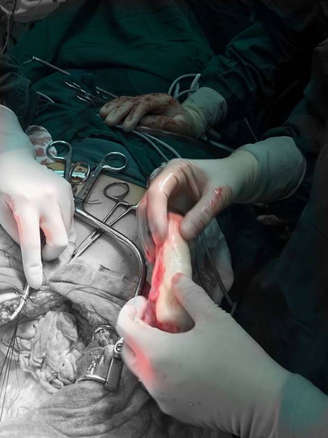 阴式手术 录像图片