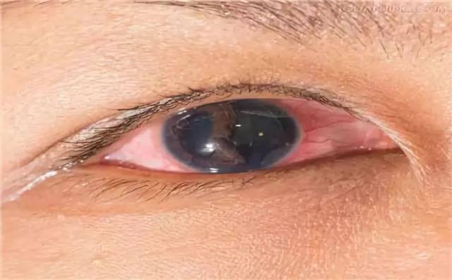 角膜炎是由于眼角膜外伤感染或过敏而引起的角膜炎症
