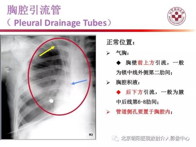 如何利用床旁x線胸片評價重症患者置管情況