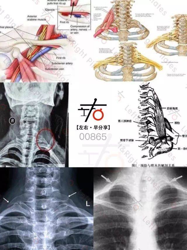 双侧颈肋图片,双侧唇裂图片,双侧额叶图片_文秘苑图库