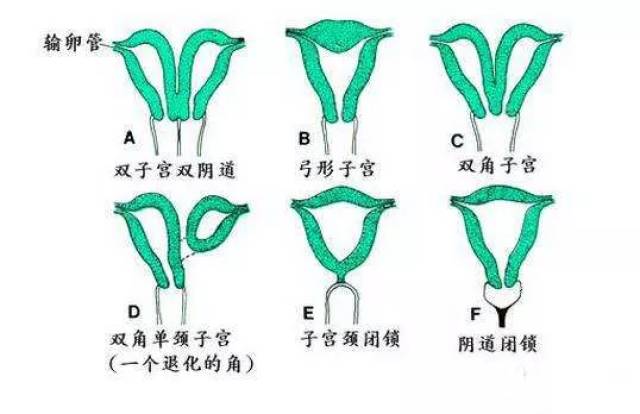 子宫畸形种类图片