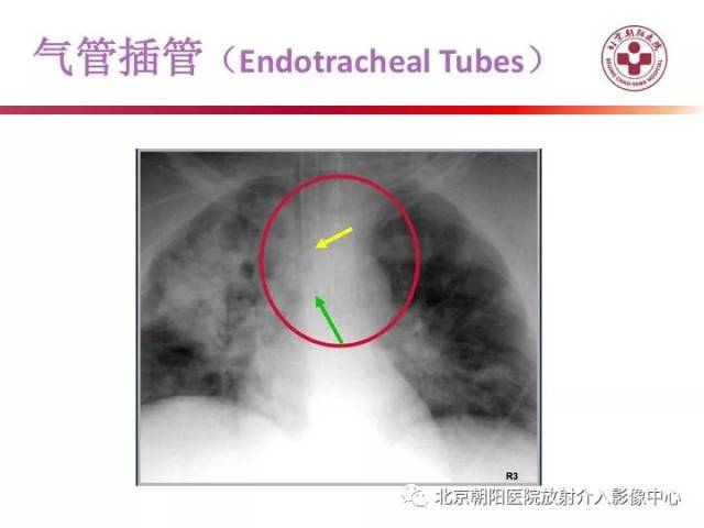 气管切开位置体表定位图片