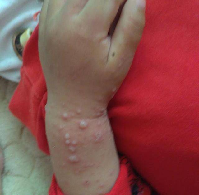 孩子出现强疑似手足口病症, 全家提心吊胆