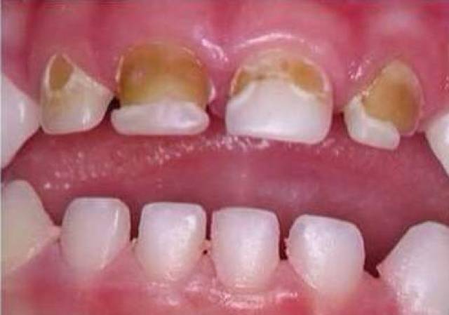 02  儿童烂牙的罪魁祸首 除了"催肥",喝果汁还很伤牙齿.